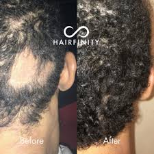 Although not completely proven, vitamin d deficiency may be a possible cause of alopecia areata. Buy Hairfinity Hair Growth Oil Serum And Vitamins With Biotin Hair Growth Treatment To Prevent Hair Loss And Stimulate Hair Follicles To Stop Hair Loss And Regrow Hair Targets Causes