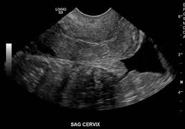 Ultrasound: Pelvic - Wikem