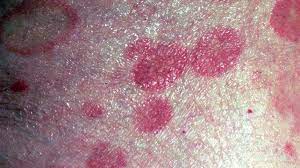 Like skin cancer on other body parts, there are 3 major types of skin cancer on the scalp. Skin Cancer Rash Itchiness And Symptoms