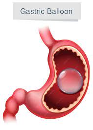 Premium Vector | Human anatomy gastric balloon illustration