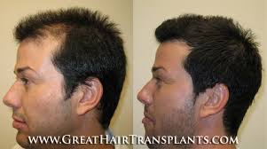 Affordable Hair Transplant & Hair Restoration in North Carolina Wake  Lochaven