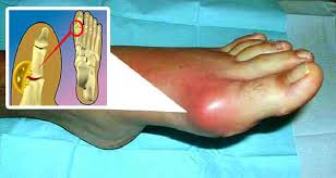 During The Last 40 Years Gout Disease A Painful Inflammatory Arthritis This Disorder Has Increased Considerably As It Inflammatory Arthritis Arthritis Gout