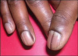At first, the lines may be plumb colored but they then to darken with time so that in a couple of days, they become brown or. Evaluation Of Nail Abnormalities American Family Physician