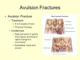 An avulsion fracture is an injury to the bone in a location where a tendon or ligament attaches to the bone. Injuries To Pelvis And Hip Ppt Download