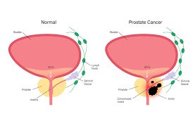 But sometimes they spread to other organs and start new tumors. Circulating Tumour Dna As A Prognostic Tool In Prostate Cancer