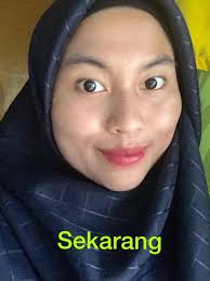 Erha acne spot gel yang memiliki tekstur gel bening berfungsi untuk mengurangi peradangan. List Produk Rawat Jerawat Parut Hitam Yang Penting Semuanya Boleh Beli Di Drugstore Hijabista