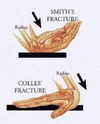 Smith And Colles Fracture Google Search Radiology Student Medical Laboratory Medical Technology