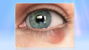 A bandage lens is a great way to manage the abrasion in the short term until you can see your surgeon to flip the lid and remove the offending suture. Styes Cysts And Eyelid Growths Eye Institute At Medical Center