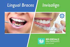 According to general research, braces take approximately months or years. Are Lingual Braces Or Invisalign Better For You