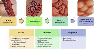 Ovarian epithelial cancer is the most common type of ovarian cancer. Endometriosis Associated Ovarian Cancer What Have We Learned So Far Sciencedirect
