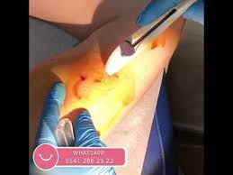 Deri Alti Implant Nasil Takilir Implant Yerlestirme Videosu Op Dr Meral Sonmezer Youtube