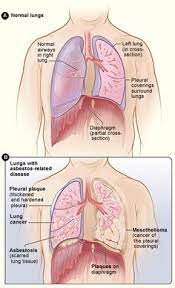 Glioblastoma is an aggressive cancer of the brain. 8 Asbestos Ideas Asbestos Mesothelioma Infographic