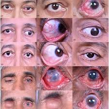Clinical course of two patients with bilateral ocular surface squamous...