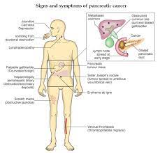 November is pancreatic cancer awareness month. Signs And Symptoms Of Pancreatic Cancer Pancreas Grepmed