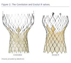 Balloon Or Self Expandable Tavi