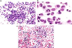 Oligodendroglial Tumors | SpringerLink