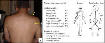 Parsonage Turner Syndrome Initially Suspected Of Being Orthopedic Diseases In A Primary Care Setting A Case Report Yabe Journal Of Medical Cases