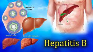 Hepatitis c ialah penyakit yang disebabkan oleh virus. 12 Cara Pencegahan Hepatitis B Jaman Now Prosehat