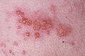 La culebrilla (herpes zóster) es un sarpullido doloroso que se presenta en un lado de la cara o el cuerpo. Herpes Zoster Or Shingles Contour Dermatology