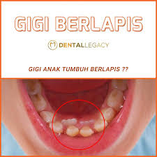 3 anak malaysia kuasai empayar susu segar negara. Gigi Anak Tumbuh Berlapis Ibu Klinik Pergigian Nurul Facebook