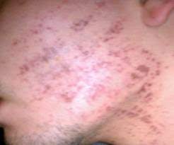 That's why they say to wear sun screen while going out into the sun bc it causes blotches on your body. Blogs How To Prevent Damage From Laser Hair Removal In Dark Skins