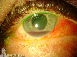 Image result for Hyphema