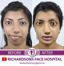 Hemifacial Microsomia correction results by Prof. Dr. Sunil Richardson