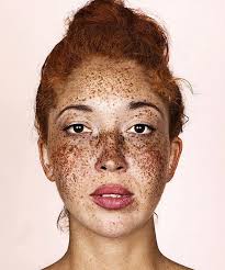 Image result for Freckled skin