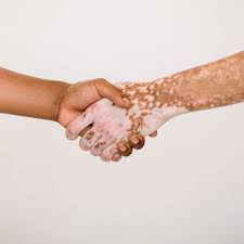 It's caused by the lack of melanin, which is the pigment in skin. Surgical Interventions Safe Effective Way To Manage Vitiligo