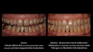 Dahinter sitzt noch der weisheitszahn, ein relikt aus der steinzeit.er kommt als letzter zum vorschein, geht aber oft als erster wieder: Implantat Zahnbrucke In Ravensburg Zahnarztpraxis Dr Emmerich 2