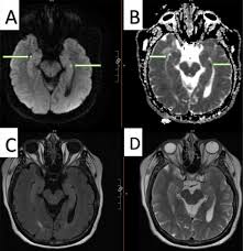 Image result for Transient Global Amnesia