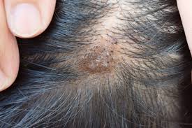 Image result for dry scabs on the head in children