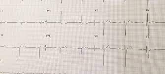 Eam = enfarte agudo do miocárdio. Sinais De Infarto Agudo Do Miocardio Inferior Medicina De Emergencia