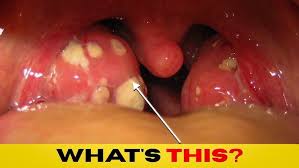 Image result for Tonsillitis