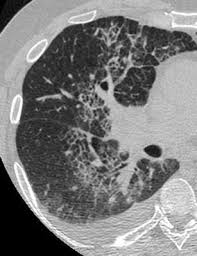 Image result for septal pattern