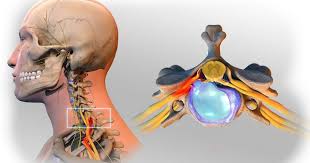 Pin By Texas Migraine Clinic On Www Texasmigraineclinic Com Herniated Disc Cervical Disc Bulging Disc