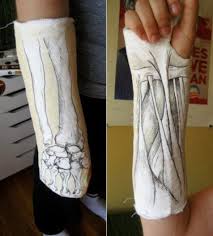 Awesome Thechive Cast Art Broken Hand Cast It Cast