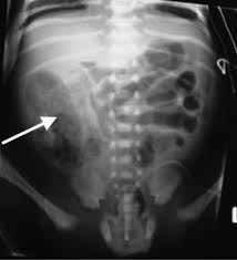 Image result for Necrotizing Enterocolitis