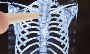 Failed Back Surgery Syndrome Hooman Melamed Md