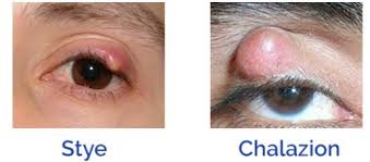 Ketumbit berpunca dari kalenjar minyak pada kelopak mata yang tersumbat jika anda mengalami how to treat chalazion at home (cara merawat ketumbit mata di rumah) 自己怎么样治疗麦粒肿（针. Ketumbit Pada Mata Dr Zubaidi Hj Ahmad Menulis