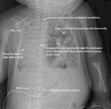 Xray Of Congenital Diaphragmatic Hernia Mechanical Ventilation Respiratory Therapy Picu Nurse