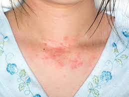Guide To Allergic Skin Rashes