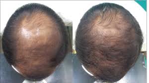 I'm a male who is using avodart 0.5 mg/day and finasteride 1mg/day to battle hair loss. Indian Journal Of Dermatology Venereology And Leprology Superiority Of Dutasteride Over Finasteride In Hair Regrowth And Reversal Of Miniaturization In Men With Androgenetic Alopecia A Randomized Controlled Open Label Evaluator Blinded Study