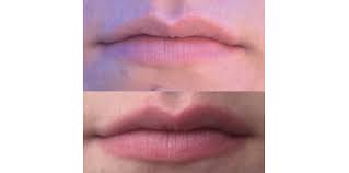 Pmd Kiss Lip Plumping System Review Hannah Heartss