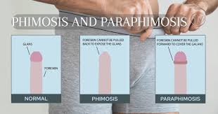 Image result for paraphimosis