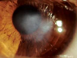 Management Of Corneal Haze After Photorefractive Keratectomy |  Ophthalmology And Therapy