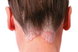 How to use cbd oil all comes down to personal preference. Cbd Oil For Psoriasis Does It Work Or Just A Hype The Truth Theihcc Com