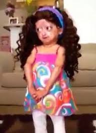 Adalia Rose The Six Year Old Girl With Body Of An Old Woman Due To Progeria Daily Mail Online