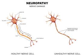 How bad can peripheral neuropathy get? Syndromes Mimic Nerve Entrapment Of Peripheral Neuropathy