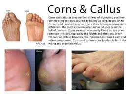 One Simple Trick That Will Eliminate Your Corns And Calluses Corn Removal Toe Corn Removal Dry Skin On Face